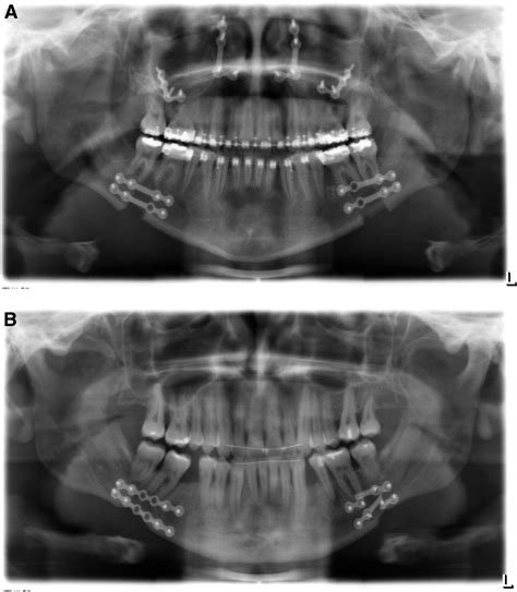 removing fixation plates after jaw surgery